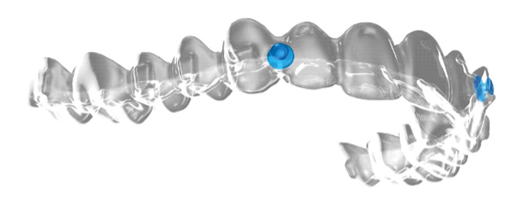 Angel Aligner beugel